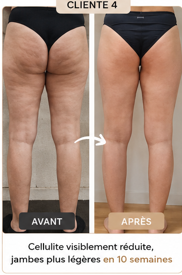 Cliente 4 avant-après : cellulite réduite, jambes plus légères en 10 semaines